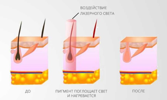 Воздействие лазерного света Воздействие лазерного света